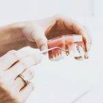 Ile kosztują implanty zębów? Implanty - cena